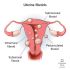 Uterine Fibroids: Causes, Symptoms and Treatments