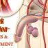 Common Causes of Erectile Dysfunction (ED) and How to Address Them
