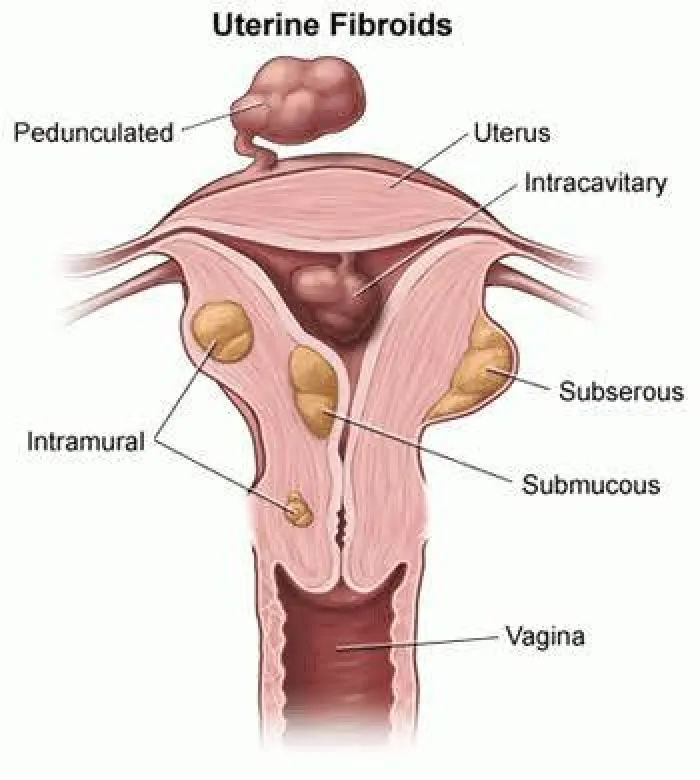 Causes of Fibroids in Women