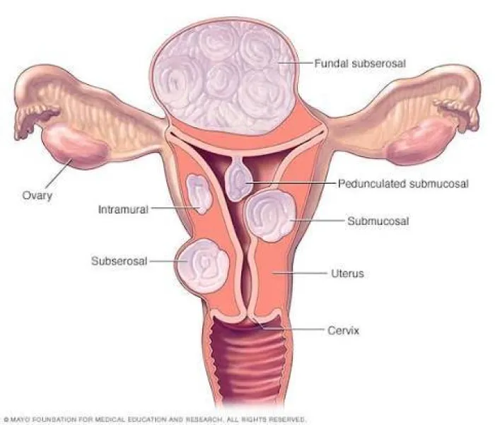 Symptoms and Treatments of Fibroids