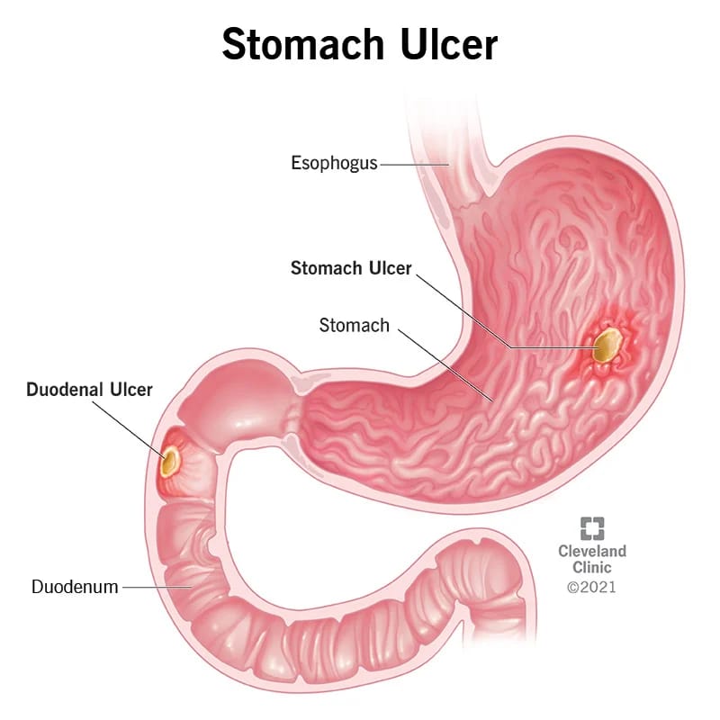 What Ulcer Patients Must Do To Reduce The Nature Of Acidity