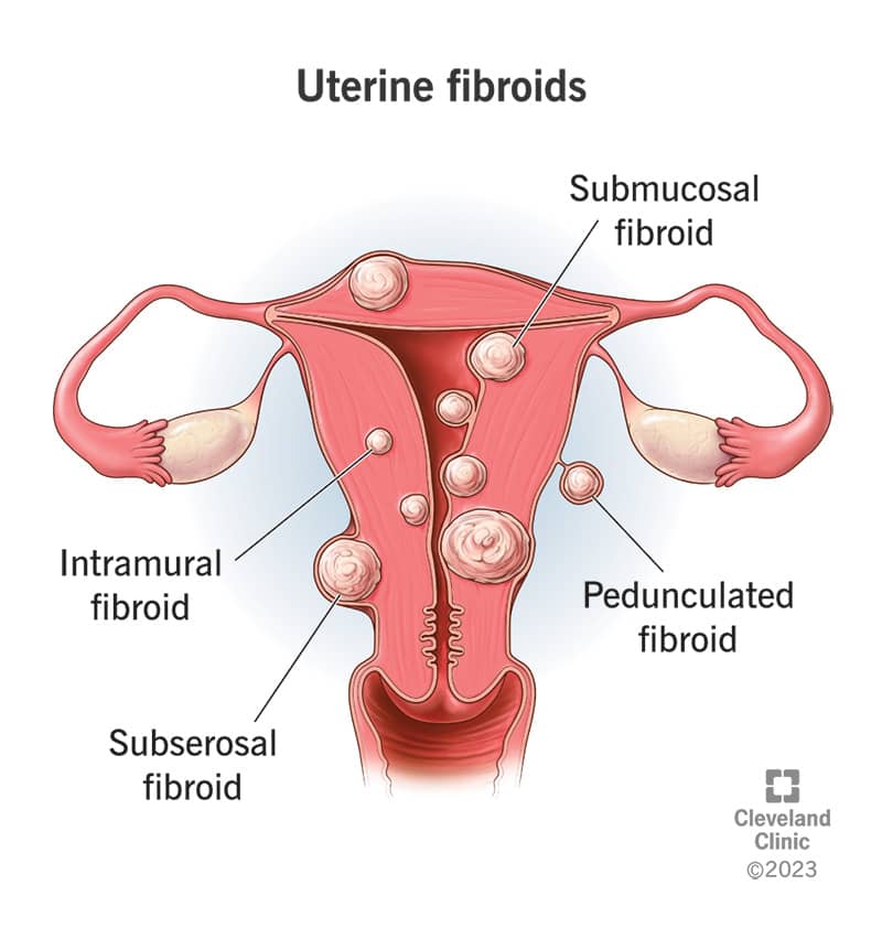 Uterine Fibroids: Causes, Symptoms and Treatments