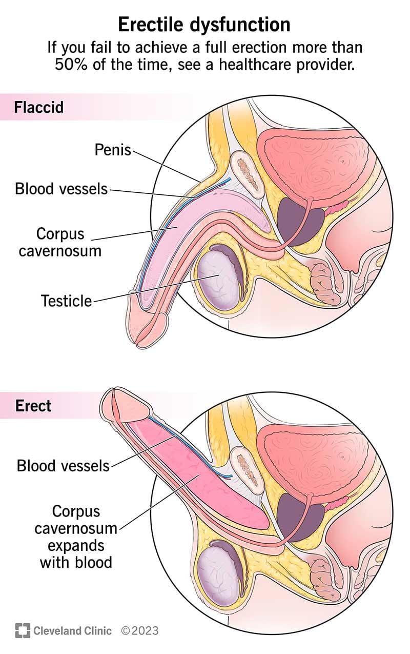 Understanding Erectile Dysfunction: Common Causes and Solutions